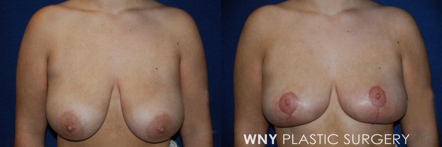 Before & After Breast Lift Case 201 Front View in Williamsville, NY