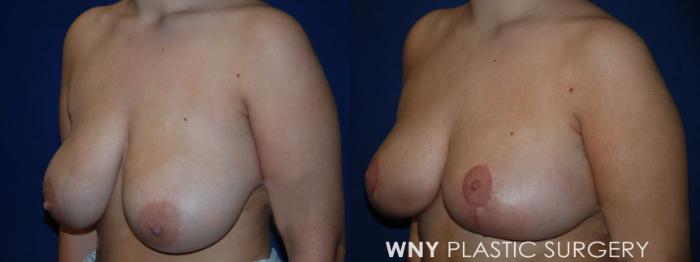 Before & After Breast Lift Case 201 Left Oblique View in Buffalo, NY