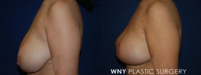 Before & After Breast Lift Case 201 Left Side View in Buffalo, NY