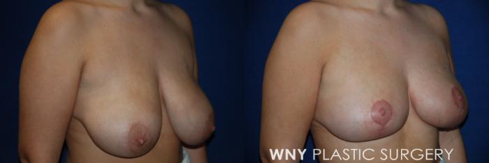 Before & After Breast Lift Case 201 Right Oblique View in Buffalo, NY