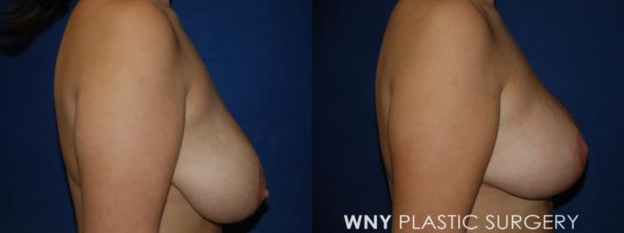 Before & After Breast Lift Case 201 Right Side View in Buffalo, NY
