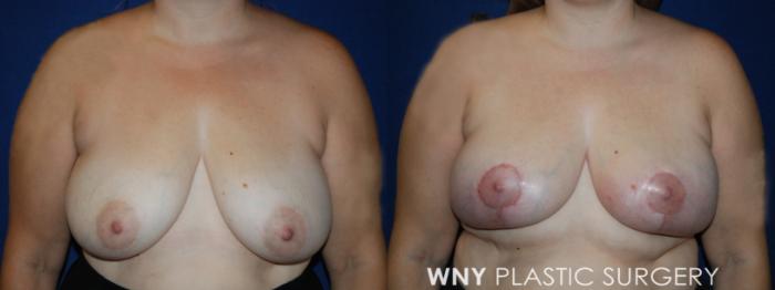 Before & After Breast Lift Case 217 Front View in Williamsville, NY