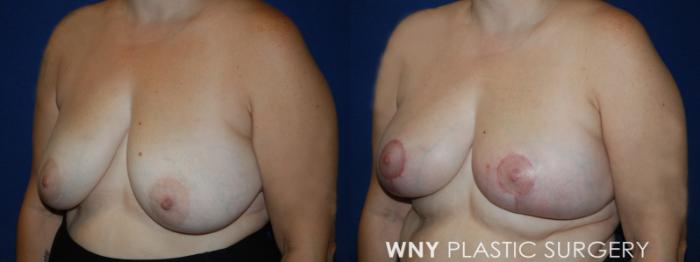 Before & After Breast Lift Case 217 Left Oblique View in Buffalo, NY
