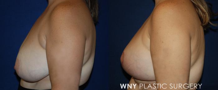 Before & After Breast Lift Case 217 Left Side View in Buffalo, NY