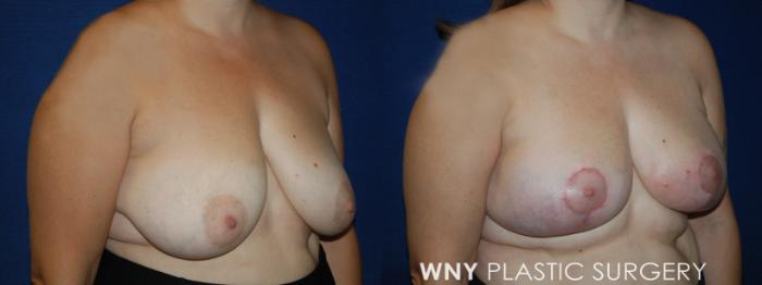 Before & After Breast Lift Case 217 Right Oblique View in Buffalo, NY