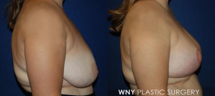Before & After Breast Lift Case 217 Right Side View in Buffalo, NY