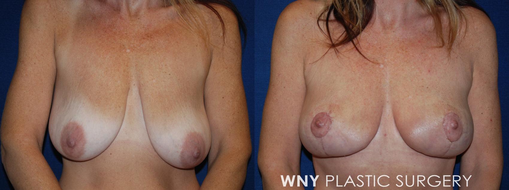 Before & After Breast Lift Case 22 Front View in Williamsville, NY