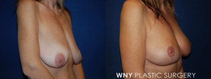 Before & After Breast Lift Case 22 Right Oblique View in Buffalo, NY