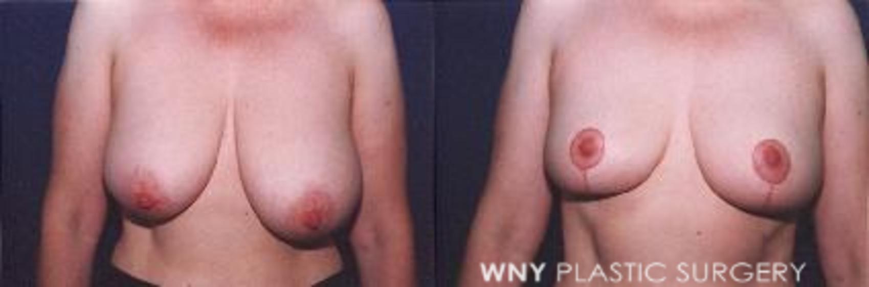 Before & After Breast Reduction Case 10 View #1 View in Williamsville, NY
