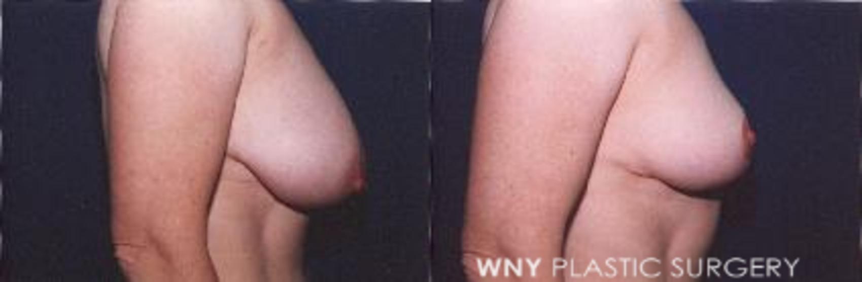 Before & After Breast Reduction Case 10 View #2 View in Williamsville, NY