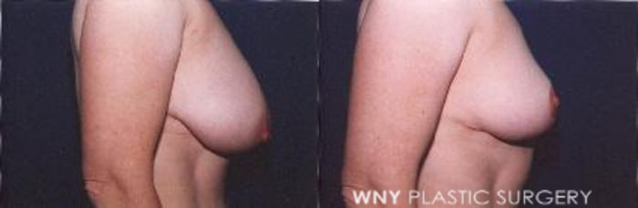 Before & After Breast Reduction Case 10 View #2 View in Buffalo, NY
