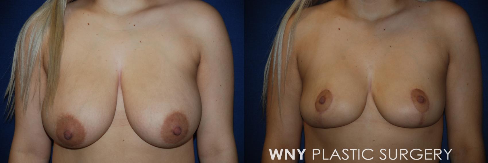 Before & After Breast Reduction Case 162 View #1 View in Williamsville, NY