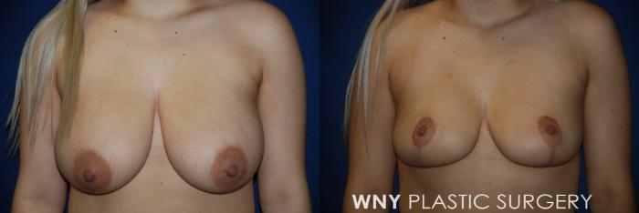 Before & After Breast Reduction Case 162 View #1 View in Buffalo, NY