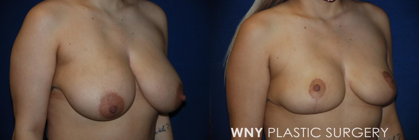 Before & After Breast Reduction Case 162 View #2 View in Williamsville, NY
