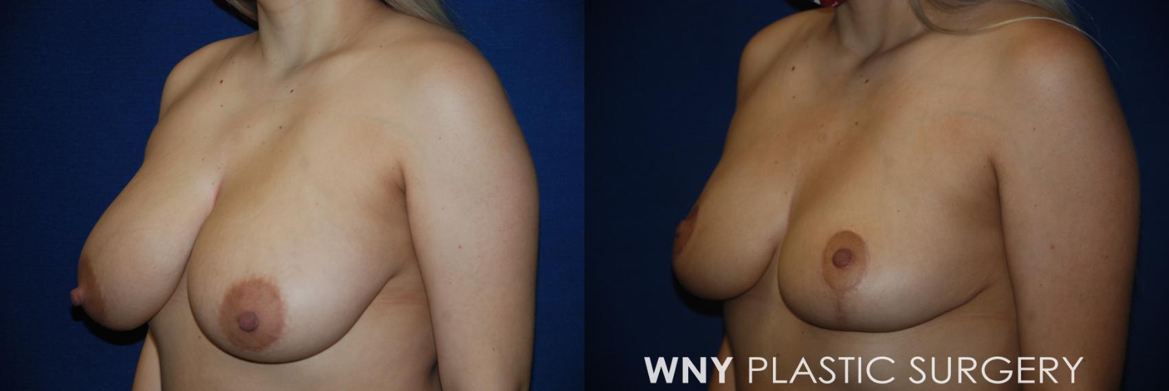 Before & After Breast Reduction Case 162 View #3 View in Williamsville, NY