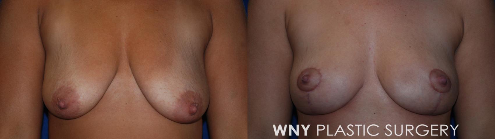 Before & After Breast Reduction Case 177 Front View in Williamsville, NY