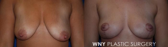Before & After Breast Reduction Case 177 Front View in Buffalo, NY