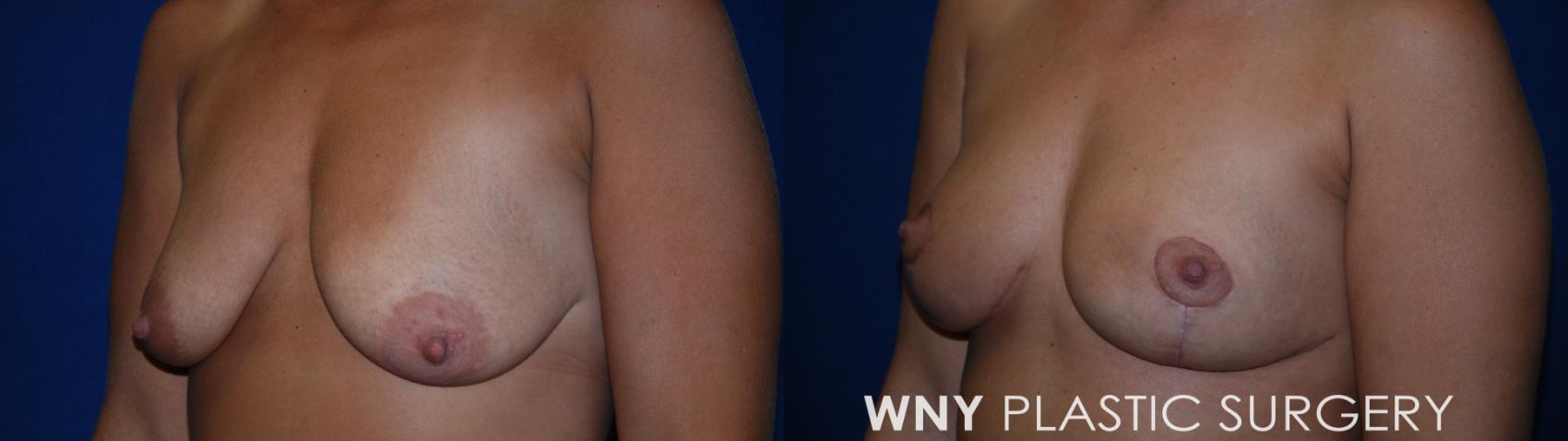 Before & After Breast Reduction Case 177 Left Side View in Williamsville, NY