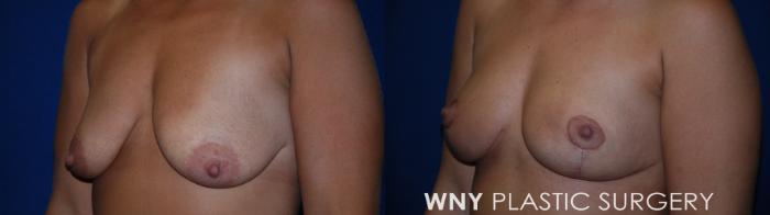 Before & After Breast Reduction Case 177 Left Side View in Buffalo, NY