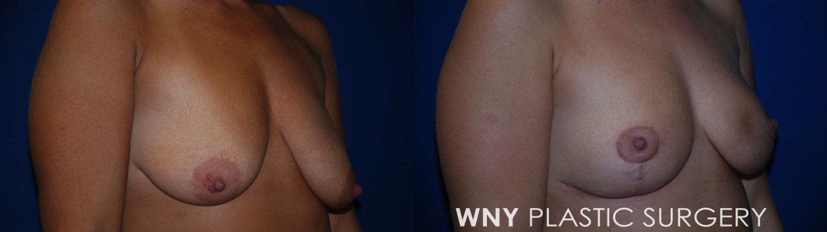 Before & After Breast Reduction Case 177 Right Side View in Williamsville, NY