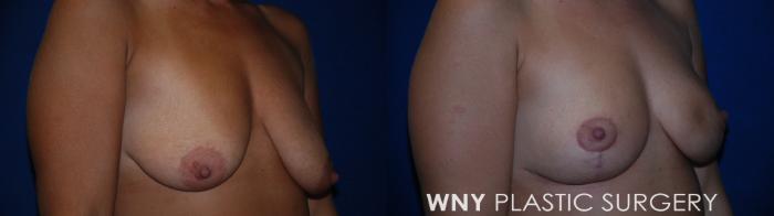 Before & After Breast Reduction Case 177 Right Side View in Buffalo, NY