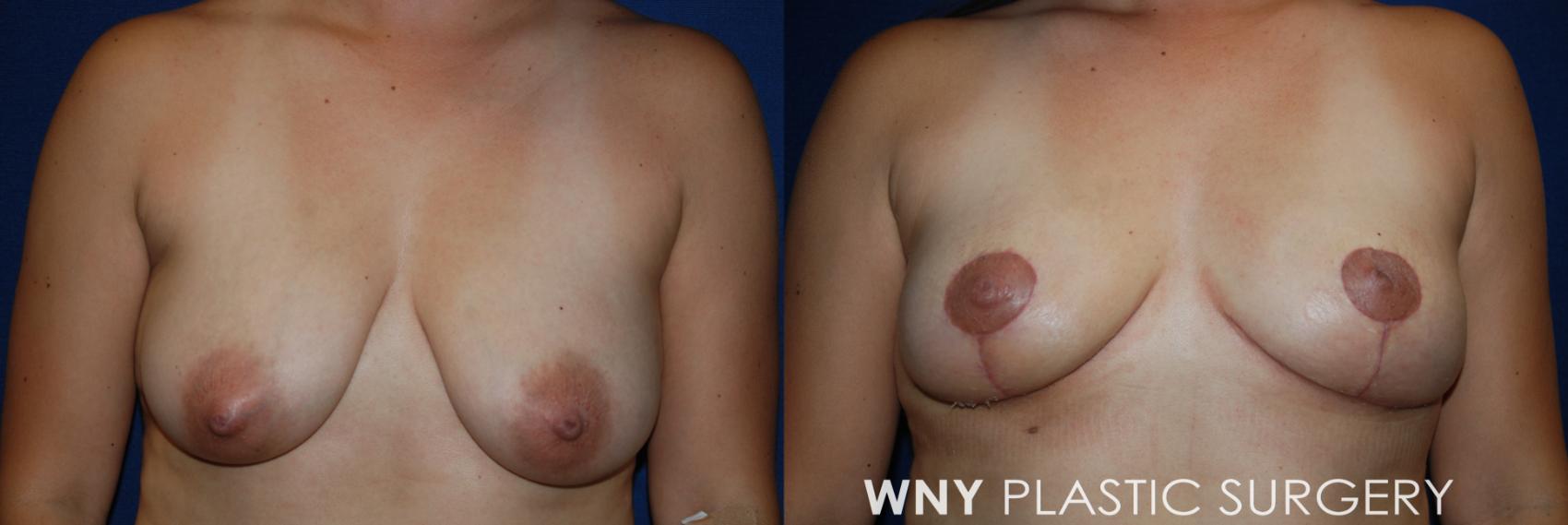 Before & After Breast Lift Case 212 Front View in Williamsville, NY