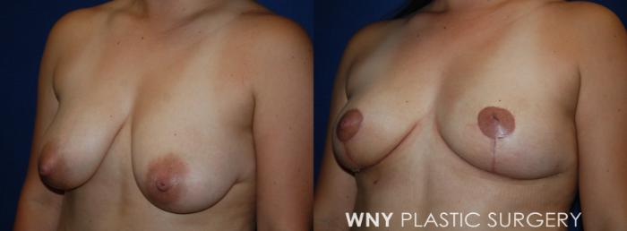 Before & After Breast Lift Case 212 Left Oblique View in Buffalo, NY