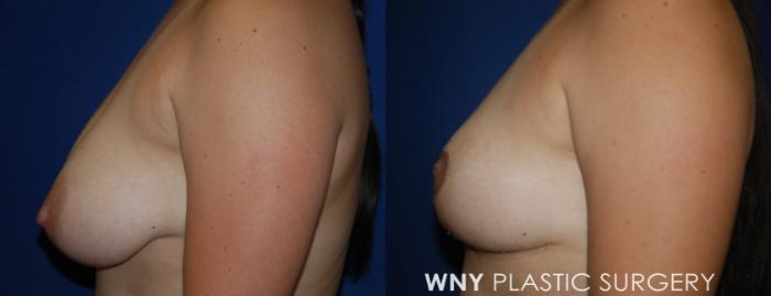 Before & After Breast Reduction Case 212 Left Side View in Buffalo, NY