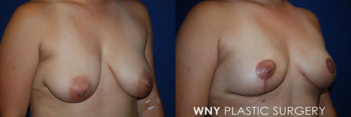 Before & After Breast Lift Case 212 Right Oblique View in Buffalo, NY