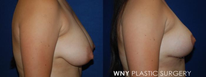 Before & After Breast Lift Case 212 Right Side View in Buffalo, NY