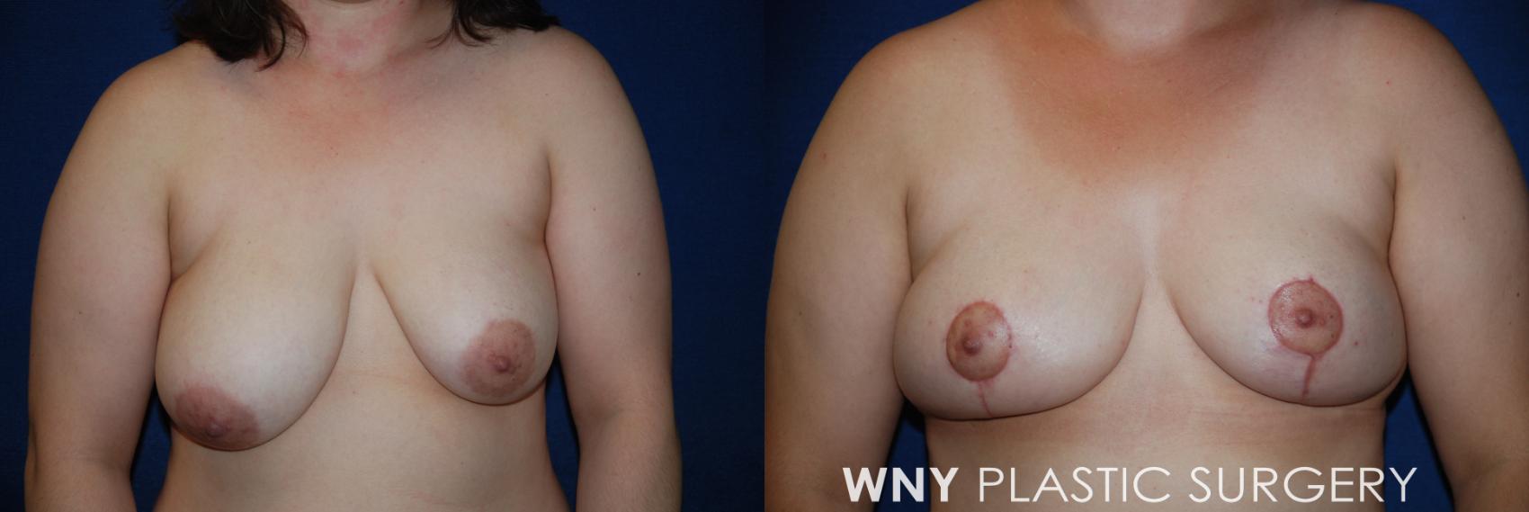 Before & After Breast Reduction Case 52 View #1 View in Williamsville, NY