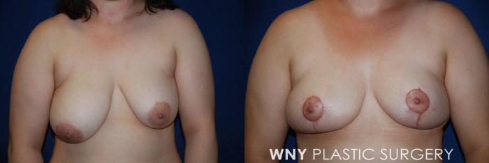 Before & After Breast Reduction Case 52 View #1 View in Buffalo, NY