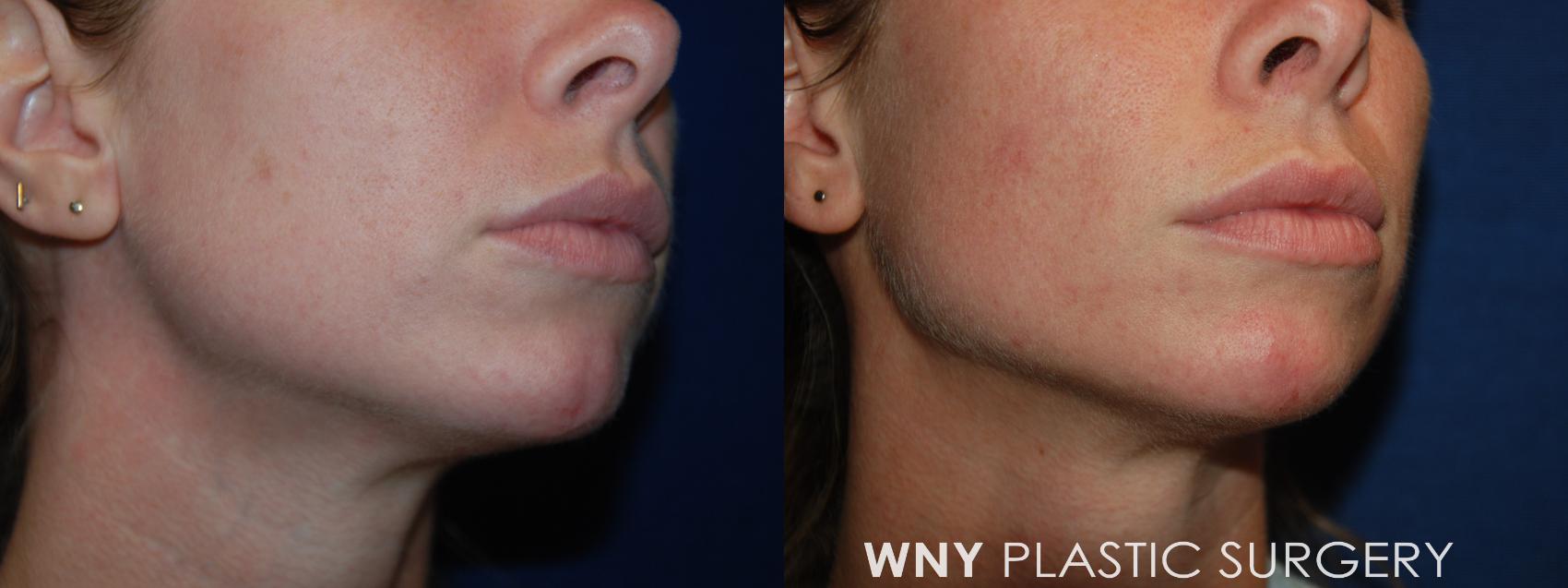 Before & After Dermal Fillers Case 132 Right Oblique View in Buffalo, NY