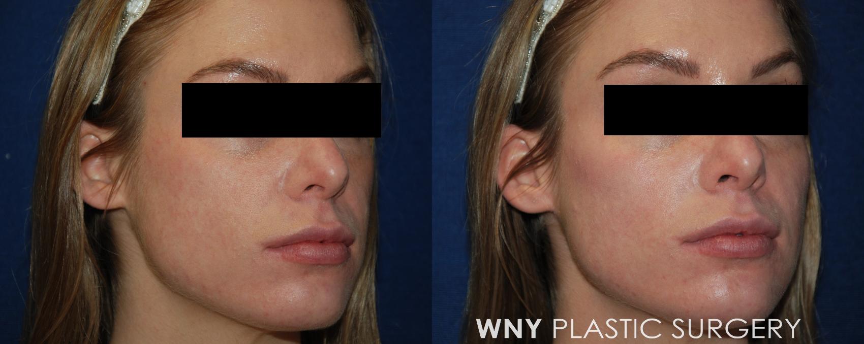 Before & After Dermal Fillers Case 136 View #1 View in Buffalo, NY