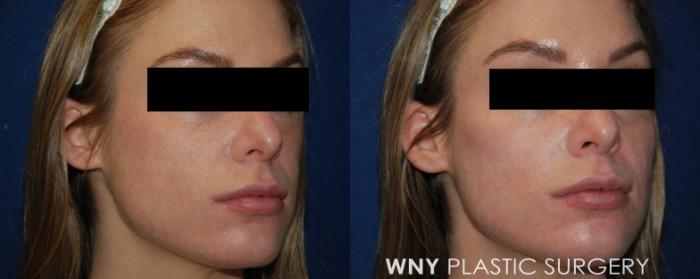 Before & After Dermal Fillers Case 136 View #1 View in Williamsville, NY