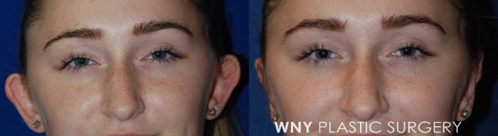 Before & After Ear Surgery Case 41 Front View in Williamsville, NY