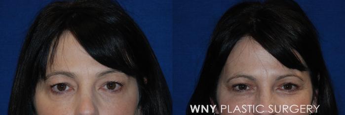 Before & After Eyelid Surgery Case 160 View #1 View in Williamsville, NY
