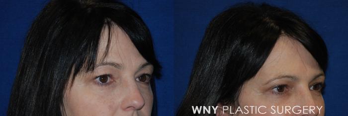 Before & After Eyelid Surgery Case 160 View #2 View in Williamsville, NY