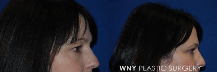 Before & After Eyelid Surgery Case 160 View #3 View in Williamsville, NY