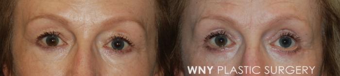 Before & After Eyelid Surgery Case 195 Front View in Buffalo, NY