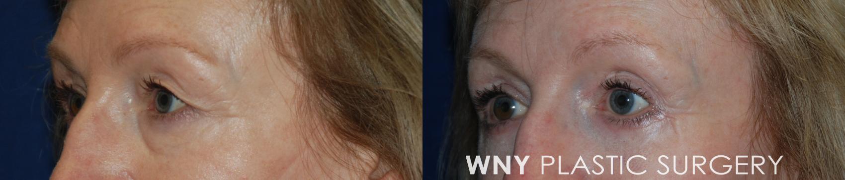 Before & After Eyelid Surgery Case 195 Left Oblique View in Williamsville, NY