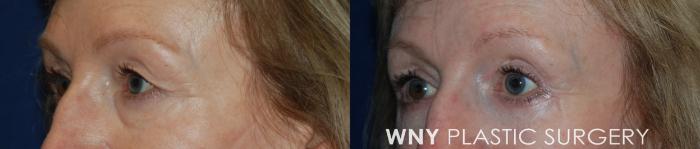 Before & After Eyelid Surgery Case 195 Left Oblique View in Buffalo, NY