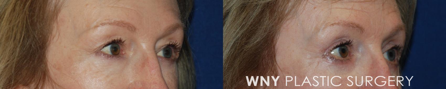 Before & After Eyelid Surgery Case 195 Right Oblique View in Williamsville, NY