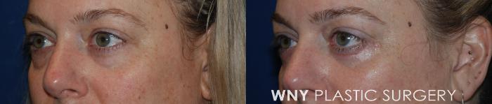 Before & After Eyelid Surgery Case 215 Left Oblique View in Williamsville, NY