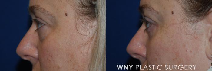 Before & After Eyelid Surgery Case 215 Left Side View in Williamsville, NY