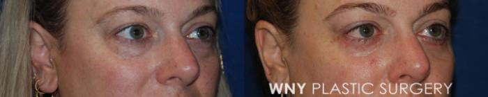 Before & After Eyelid Surgery Case 215 Right Oblique View in Williamsville, NY