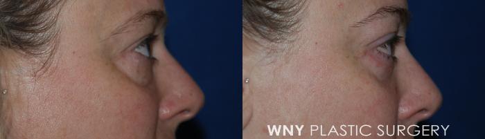 Before & After Eyelid Surgery Case 215 Right Side View in Williamsville, NY