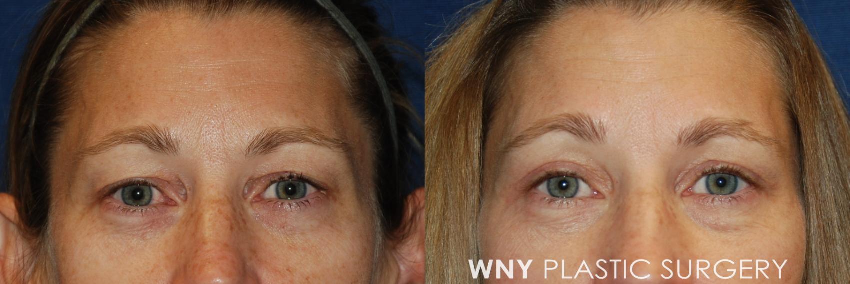 Before & After Eyelid Surgery Case 23 View #1 View in Williamsville, NY
