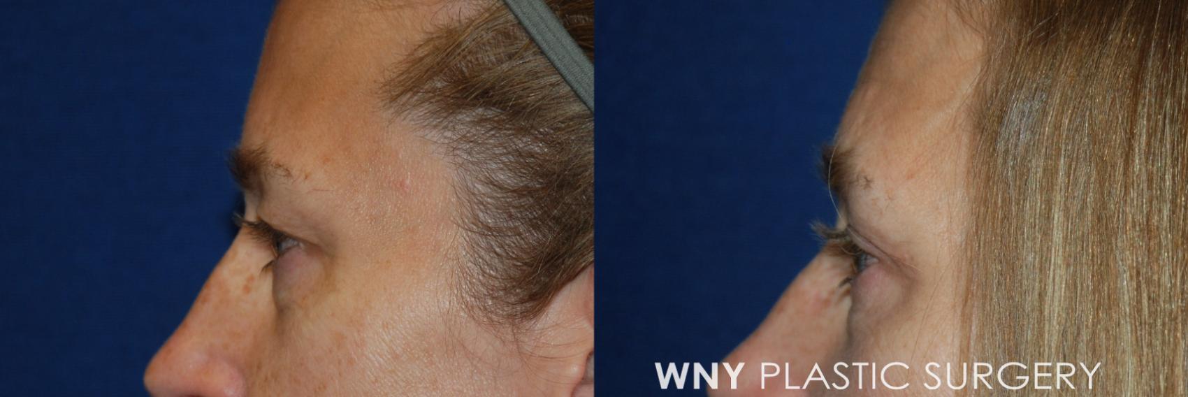 Before & After Eyelid Surgery Case 23 View #2 View in Williamsville, NY