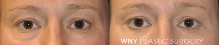Before & After Eyelid Surgery Case 233 Front View in Buffalo, NY